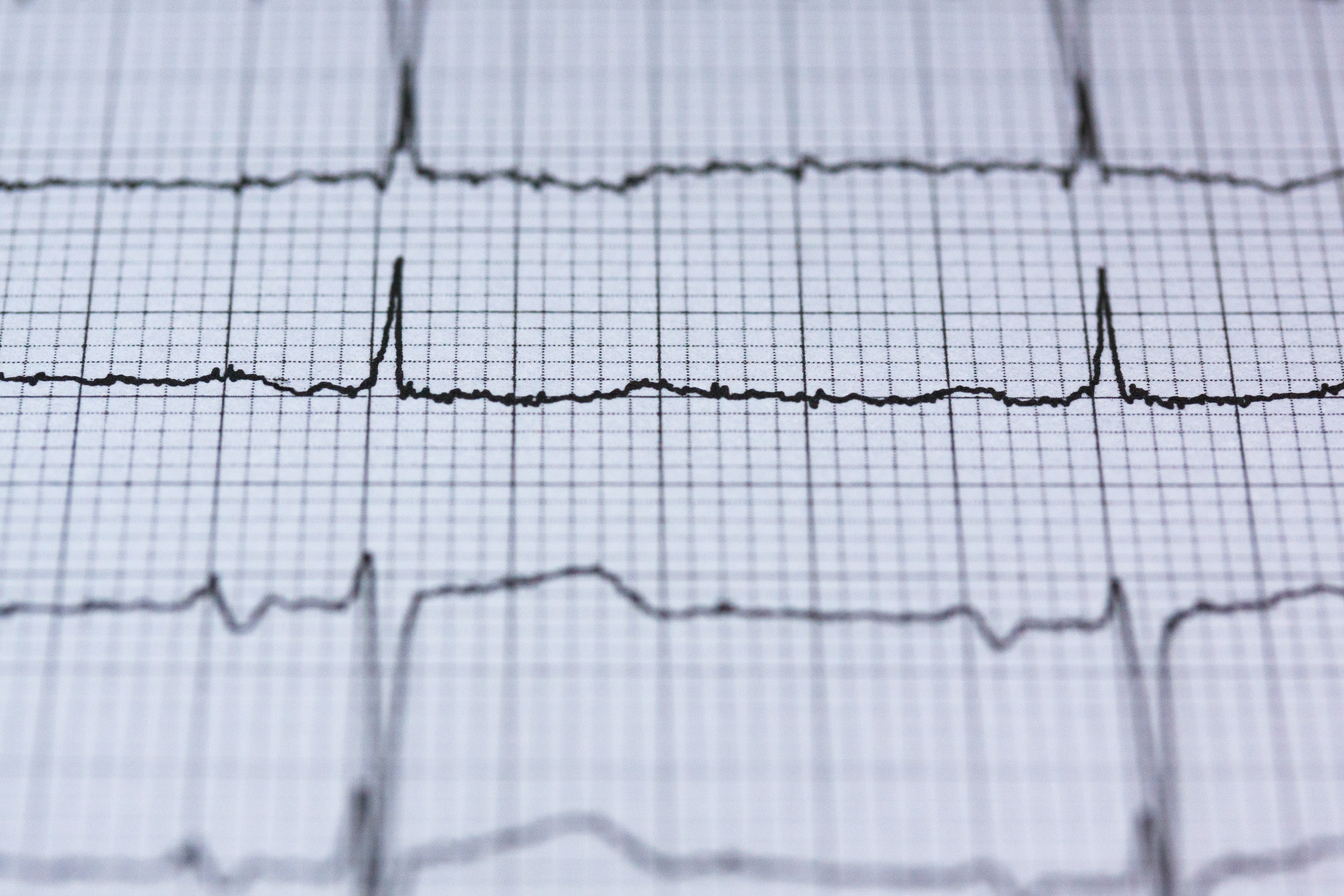 Heart arrhythmia recording